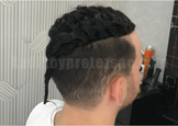 protez saç